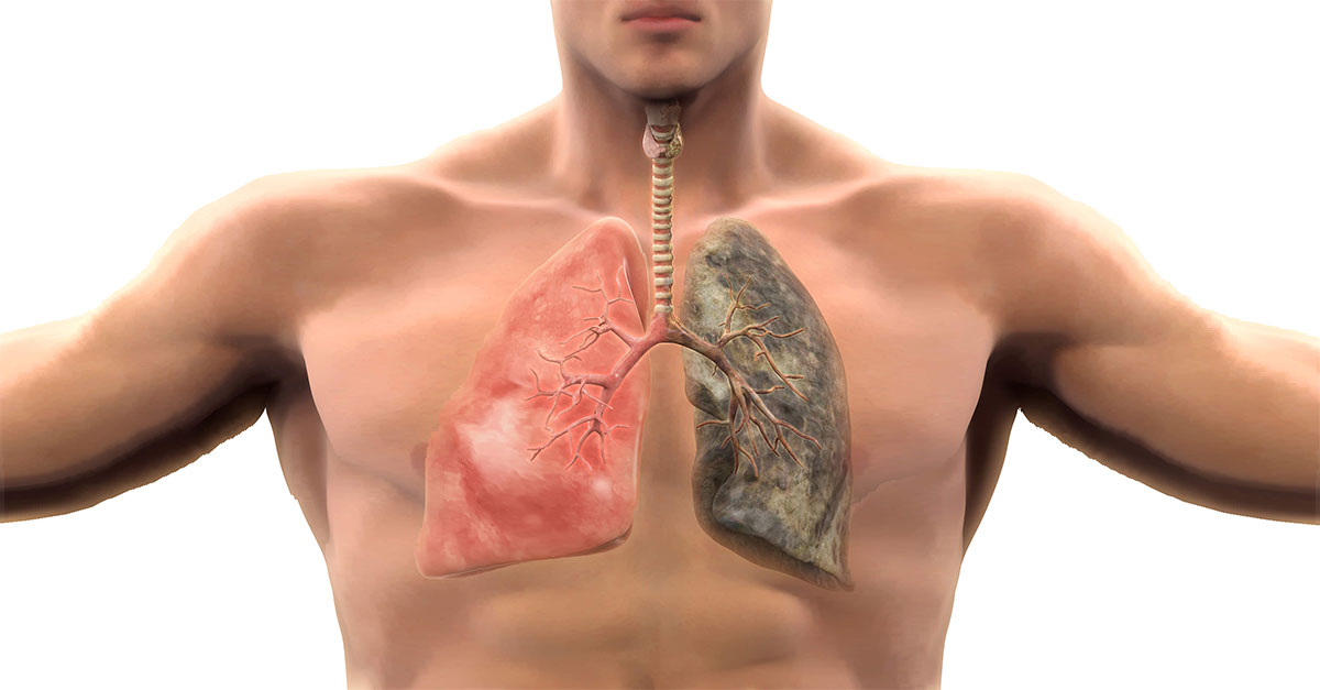 Grupo SH Brasil :: Câncer de pulmão: uma nova esperança.